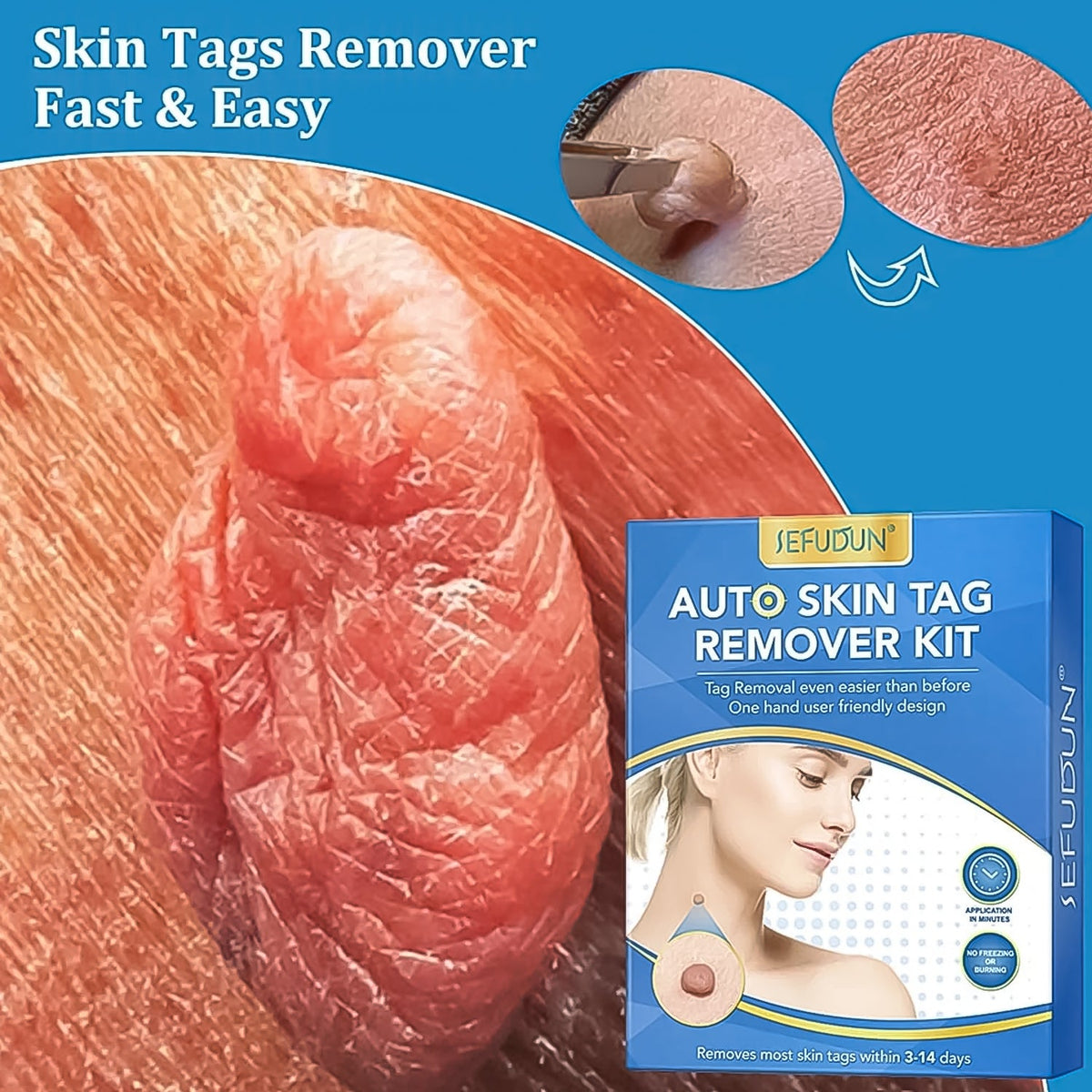 Skin Tag Remover Kit 2-in-1 – Painless Home Use
