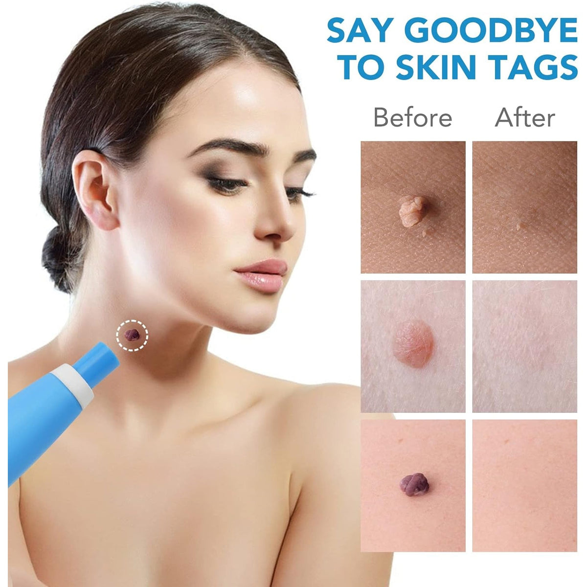 Skin Tag Remover Kit 2-in-1 – Painless Home Use