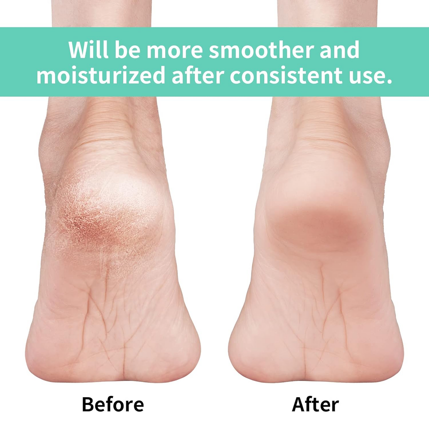 Silicone Gel Heel Socks – Cracked Heels Remedy